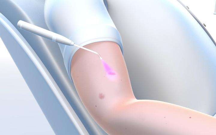Illustration of a patient being treated with a SCHOTT® Luminous Front-Emitting Diffuser in a dermatology procedure